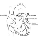 Cardiac Catheterization Heart Cath Angiography Stents Attack