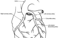 Cardiac Catheterization Heart Cath Angiography Stents Attack