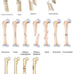 Fracture Types Orthopedic Nursing Medical Radiology Student