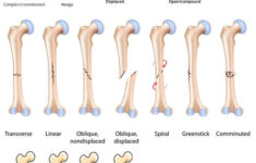 Fracture Types Orthopedic Nursing Medical Radiology Student
