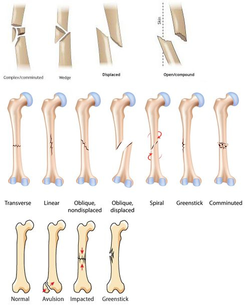 Fracture Types Orthopedic Nursing Medical Radiology Student