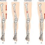 Fractures Bone Repair Anatomy And Physiology I