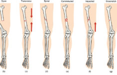 Fractures Bone Repair Anatomy And Physiology I