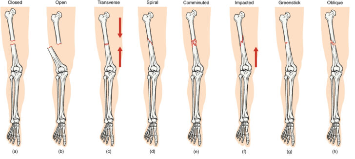 Bone Fractures Anatomy Worksheet