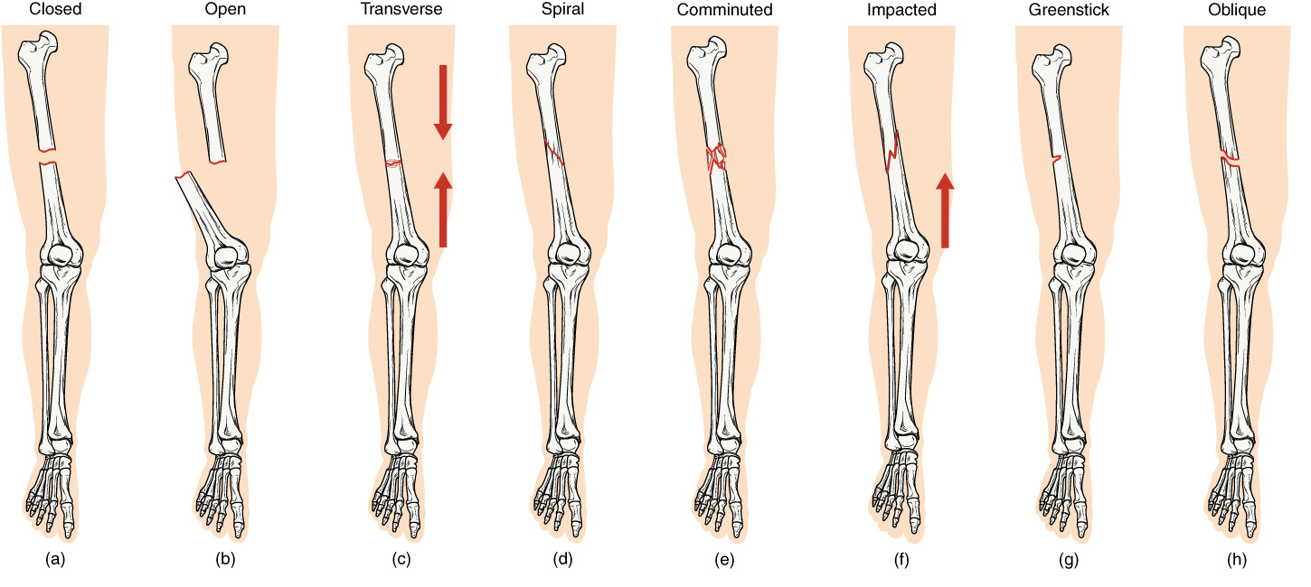 Fractures Bone Repair Anatomy And Physiology I