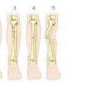 Hoylescience Licensed For Non Commercial Use Only Bone Fracture And