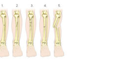 Hoylescience licensed For Non commercial Use Only Bone Fracture And