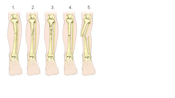 Hoylescience licensed For Non commercial Use Only Bone Fracture And 